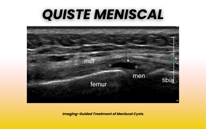2. Quiste parameniscal patologia rodilla.png